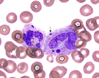 Howell Jolly body-like inclusions in a case of COVID-19