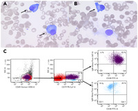 EBV-triggered hemophagocytic lymphohistiocytosis in a boy with a history of non-Hodgkin lymphoma