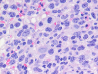 Transformed Follicular lymphomaBone marrow biopsy H&E