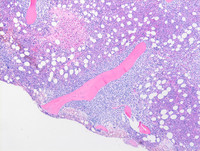 Isolated marrow involvement by transformed follicular lymphoma