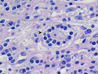 Extranodal Rosai-Dorfman disease- H&E