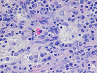 Extranodal Rosai-Dorfman disease- H&E