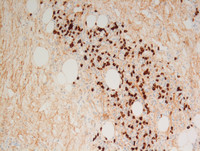 Extranodal Rosai-Dorfman disease- IgG4