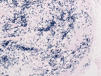 Extranodal-RosaiDorfman-disease-Kappa