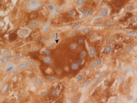 Extranodal-RosaiDorfman-disease-S100