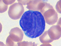 Sezary-syndromePeripheral-blood-smear