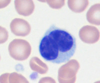 Sezary syndrome-Peripheral blood smear