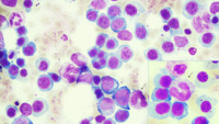 B12 and folate deficiency- bone marrow aspirate