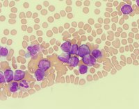 Peripheral Smear 3