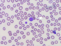 Peripheral smear showing giant platelet and numerous stomatocytes 1