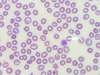 Peripheral smear showing giant platelet and numerous stomatocytes 2