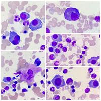 Figure 1: infiltrated plasma cell in the BM aspirate