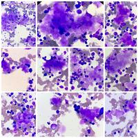 Figure 2 a,b & c: Bone marrow aspirate involvement by amyloidosis