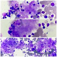 Figure 2 a,b& c: Bone marrow aspirate involvement by amyloidisis 1