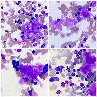 Figure 2 a,b& c: Bone marrow aspirate involvement by amyloidisis 2