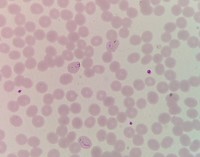 Plasmodium vivax thin smear