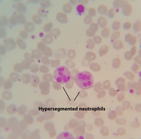 NRBCs and Hypersegmented neutrophils after splenectomy in a patient with cholecystitis 2