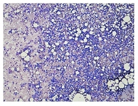 Multiple myeloma - Bone marrow smear 1