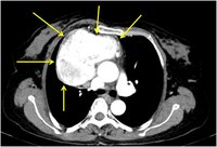 MCD - CT Thorax - Fig 1