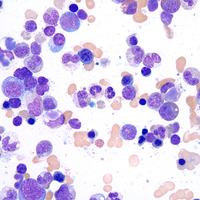 "LE" cells: Neutrophils with phagocytized nuclear material. Wright-Giemsa stain. Ob. 100x immersion oil