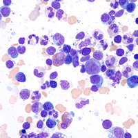 Eosinophil with phagocytized nuclear material. Wright-Giemsa stain. Ob. 100x immersion oil