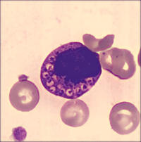 Snapper-Schneid granules in plasma cell