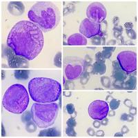 Unusual intracytoplasmic crystal  like inclusion in acute promyelocytic leukemia