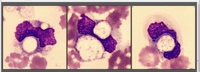 Fat embolism syndrome (COVID-19) - Figure 5