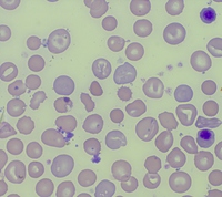 Pyruvate kinase deficiency -Peripheral smear showing  target cells, polychromatophilic cells, nRBC and prickle cells (x1000)