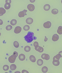 T-LGL leukemia - Peripheral smear - Figure 1