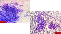 A unique case presentation of thyroid carcinoma with skip metastasis to hilar lymph nodes:  a rare report from India