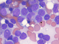 AML with myelodysplasia related changes- Bone marrow aspirate