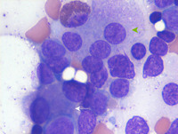 AML with myelodysplasia related changes- Bone marrow aspirate