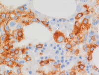 AML-with-myelodysplasia-related-changesBone-marrow-biopsy-CD34