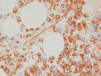 AML with myelodysplasia related changes-Bone marrow biopsy- CD34