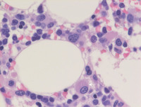 AML with myelodysplasia related changes- Bone marrow biopsy H&E