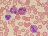 Lymphocytic variant of HES- Peripheral blood