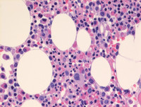 Lymphocytic variant of HES- Bone marrow biopsy