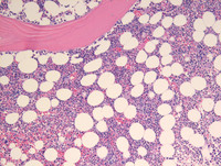 Lymphocytic variant of HES- Bone marrow biopsy