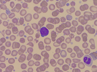 TAM - Peripheral smear