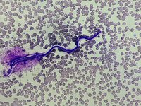 Microfilaria of Wuchereria bancrofti