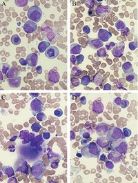 Megaloblastic anemia (100x). 1