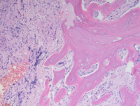 OSTEOSCLEROSIS IN POST- POLYCYTHEMIC MYELOFIBROSIS