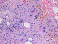 MEGAKARYOCYTE CLUSTERING IN POST-POLYCYTHEMIC MYELOFIBROSIS 1