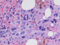 MEGAKARYOCYTE CLUSTERING IN POST-POLYCYTHEMIC MYELOFIBROSIS 2