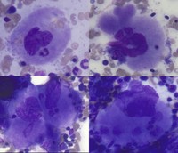 Emperipolesis in a Patient with Sickle Cell Anemia