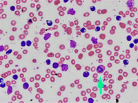 Cytoplasmic inclusions in CLL lymphocytes 1