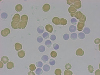 Cytoplasmic inclusions in CLL lymphocytes (Oil Red O)