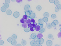 Cytoplasmic inclusions in CLL lymphocytes (Toluidine blue)