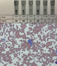 Potent cold agglutinin in a patient with SARS-CoV-2 infection